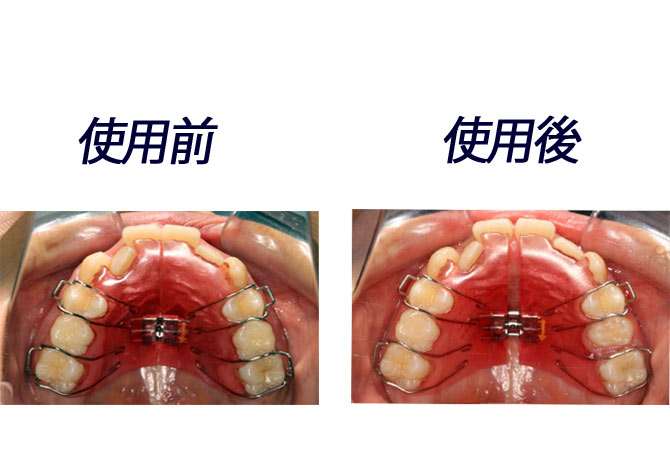 小児矯正